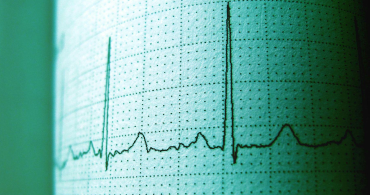 EKG graph